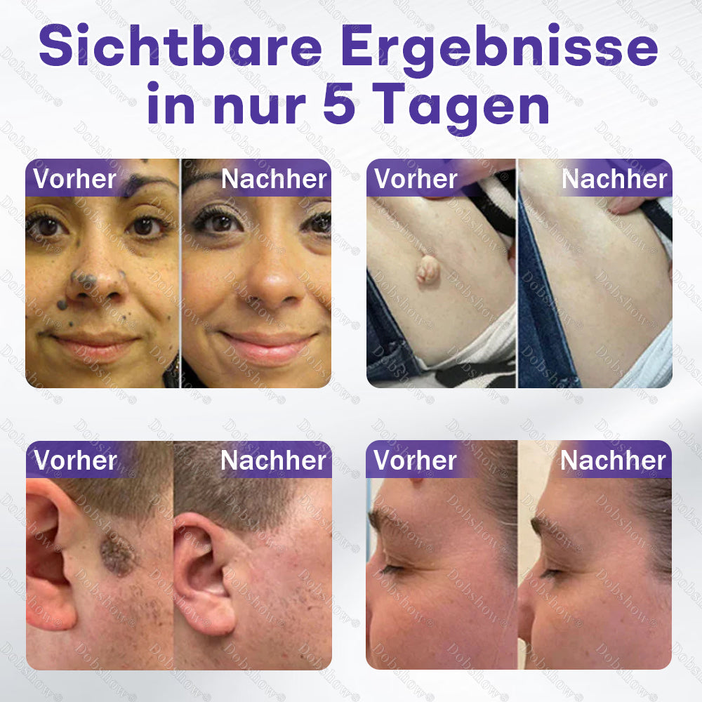 ⭐Dobshow® Mikronadelpflaster gegen Warzen und Muttermale -z