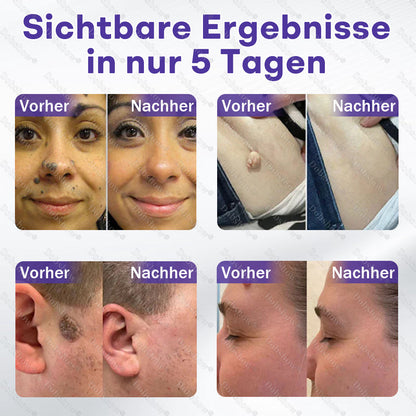 ⭐Dobshow® Mikronadelpflaster gegen Warzen und Muttermale -z