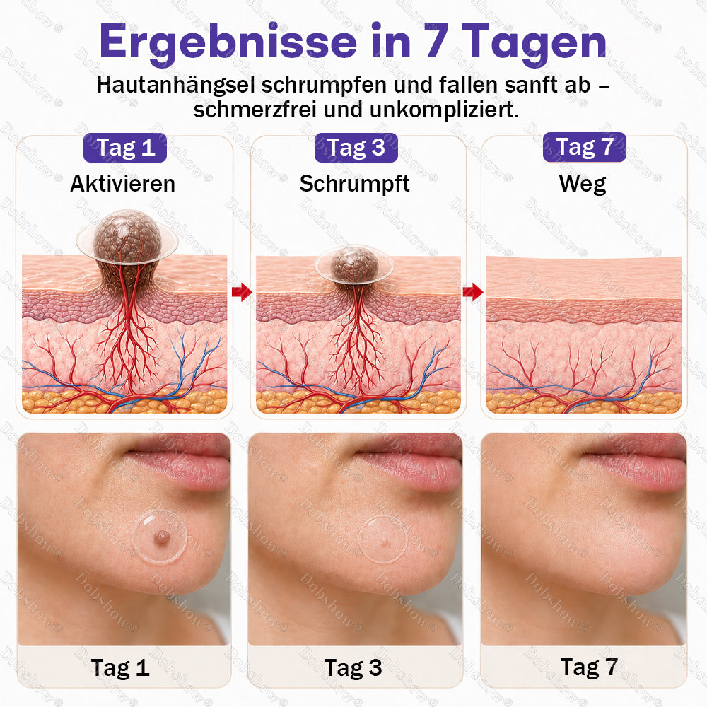 ⭐Dobshow® Mikronadelpflaster gegen Warzen und Muttermale -z
