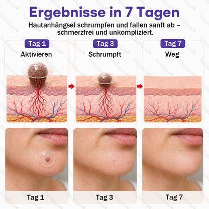 ⭐Dobshow® Mikronadelpflaster gegen Warzen und Muttermale -z